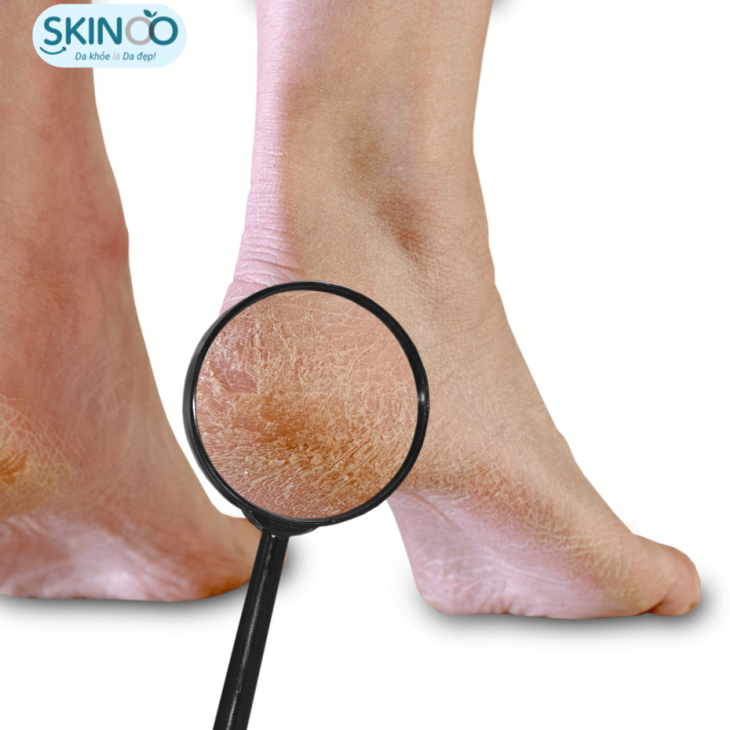 Lanolin có công dụng làm mềm da, hỗ trợ vấn đề nứt gót chân