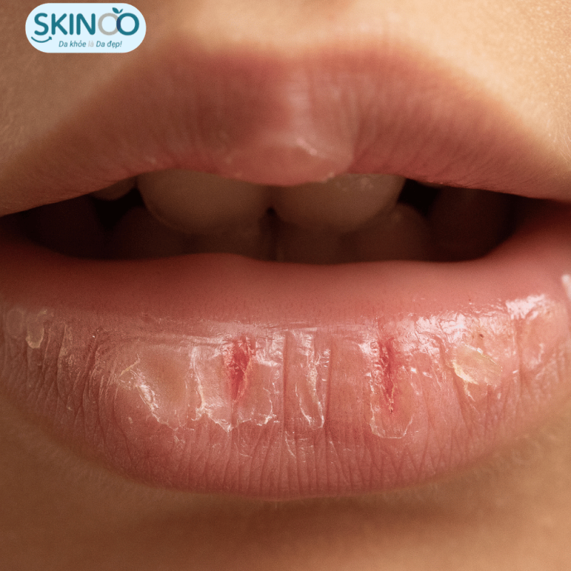 Lanolin dưỡng môi khô nứt