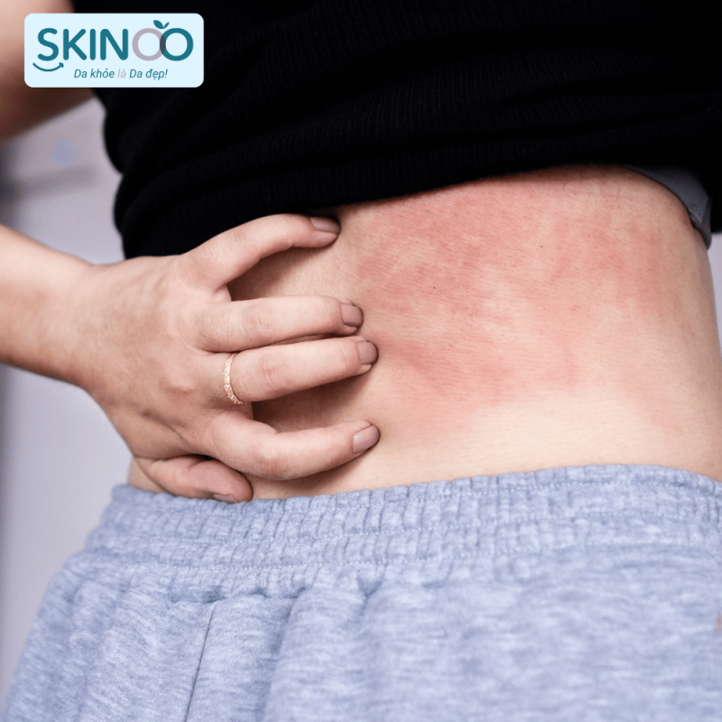ngứa là triệu chứng viêm da cơ địa nổi bật nhất