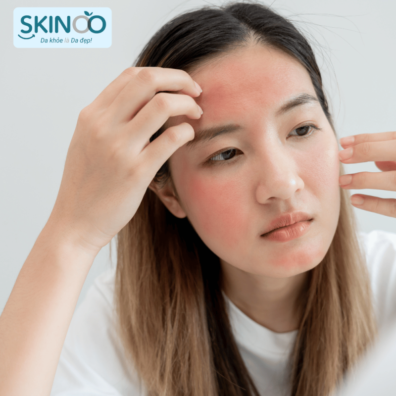 dấu hiệu hàng rào bảo vệ da bị tổn thương (3)