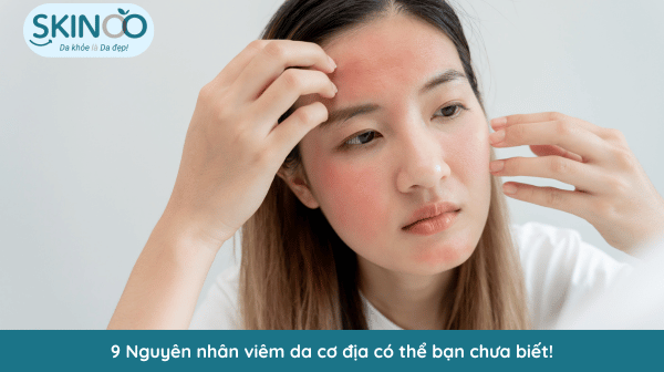 nguyên nhân viêm da cơ địa