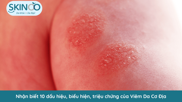 triệu chứng của viêm da cơ địa