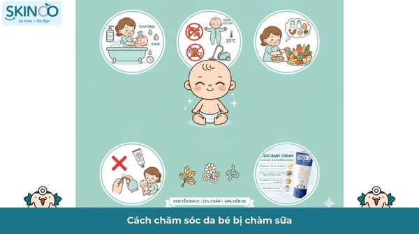Cách chăm sóc da bé bị chàm sữa