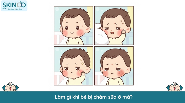 Làm gì khi bé bị chàm sữa ở má